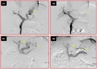 Efficacy and safety of variceal embolization for primary prophylaxis in cirrhosis patients with challenges in standard treatments: preliminary results